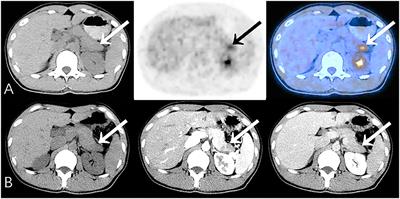 The Value of 18F-FDG PET/CT in Diagnosing Pancreatic Lesions: Comparison With CA19-9, Enhanced CT or Enhanced MR